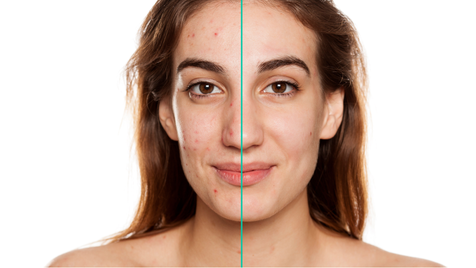 AI Blemish Removal
